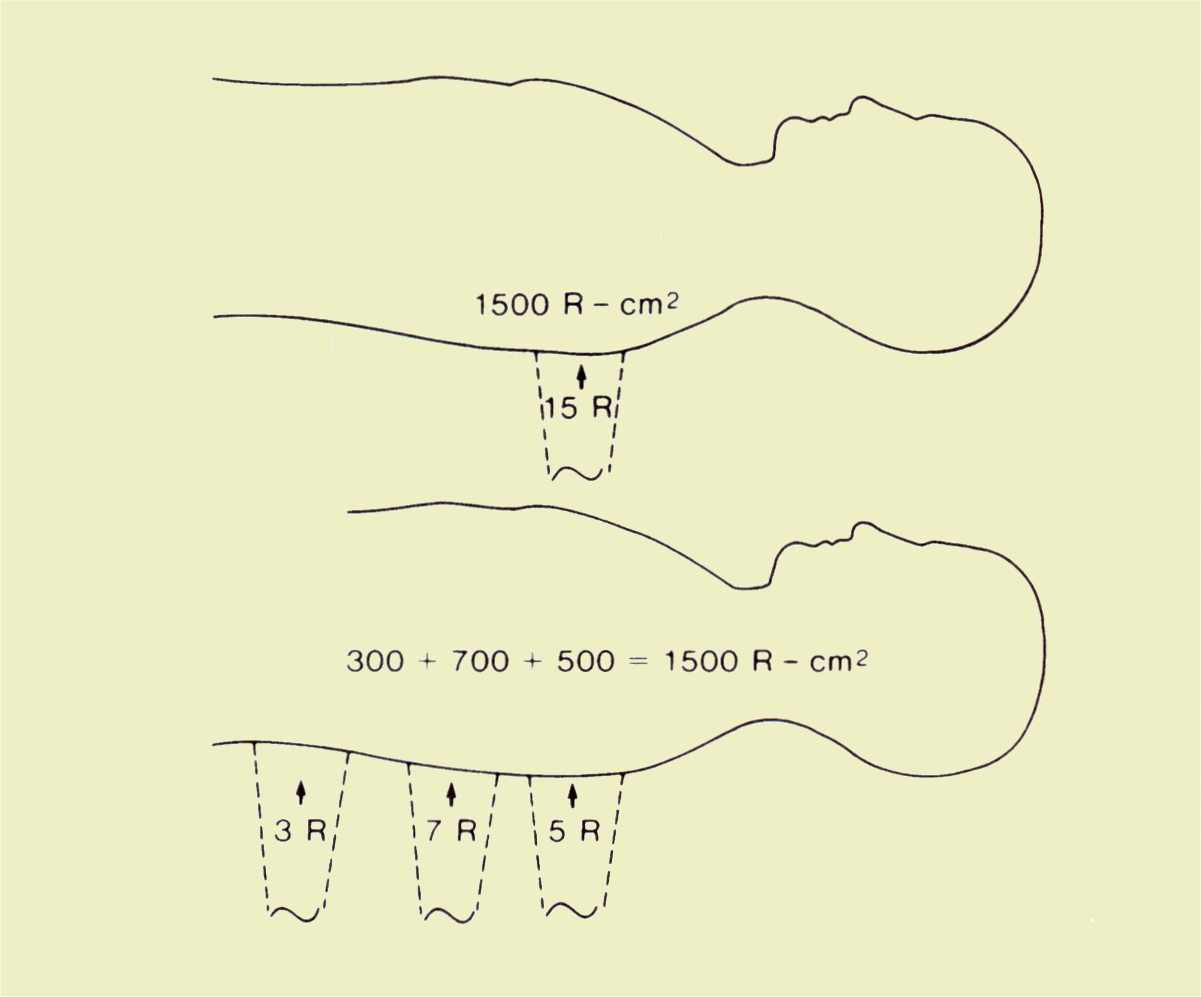 Comparison of SIE and Exposure during a Fluoroscopic Examination