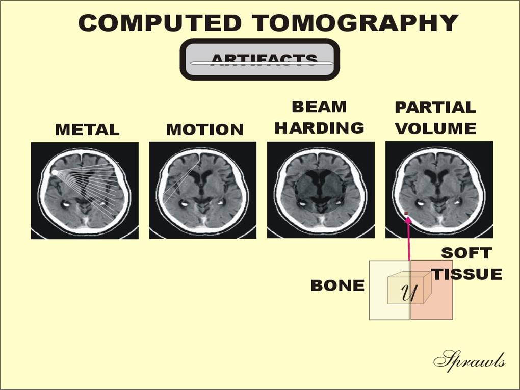 Types Of Artifacts In Ct Scan ct scan machine